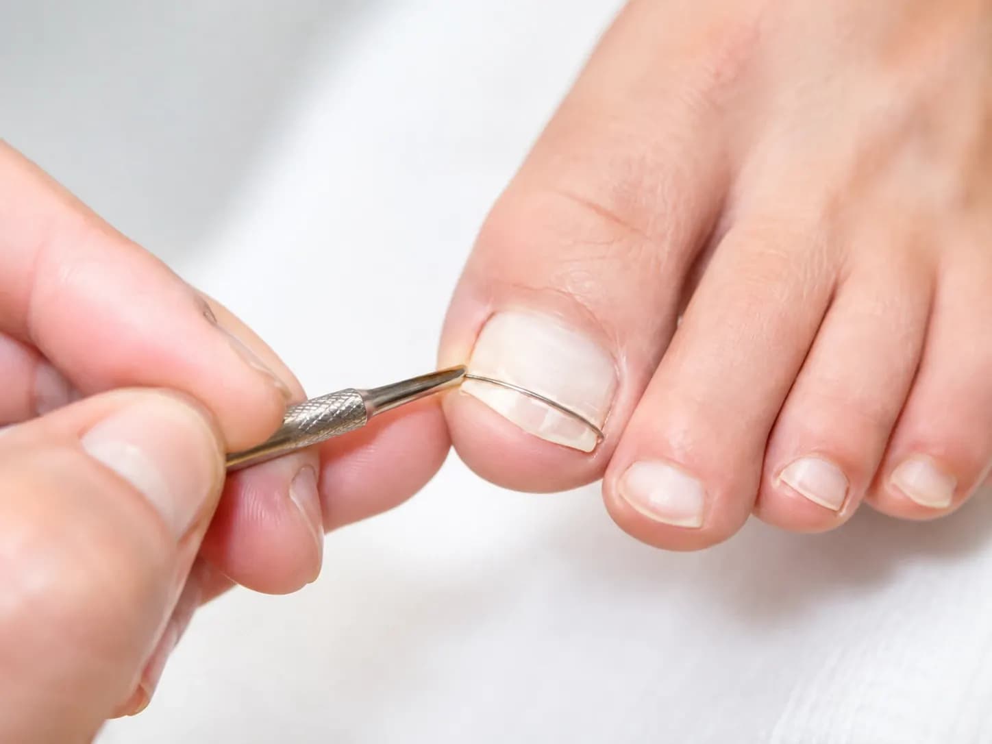 Een dunne nagelbeugel wordt met een instrument op een grote teennagel geplaatst